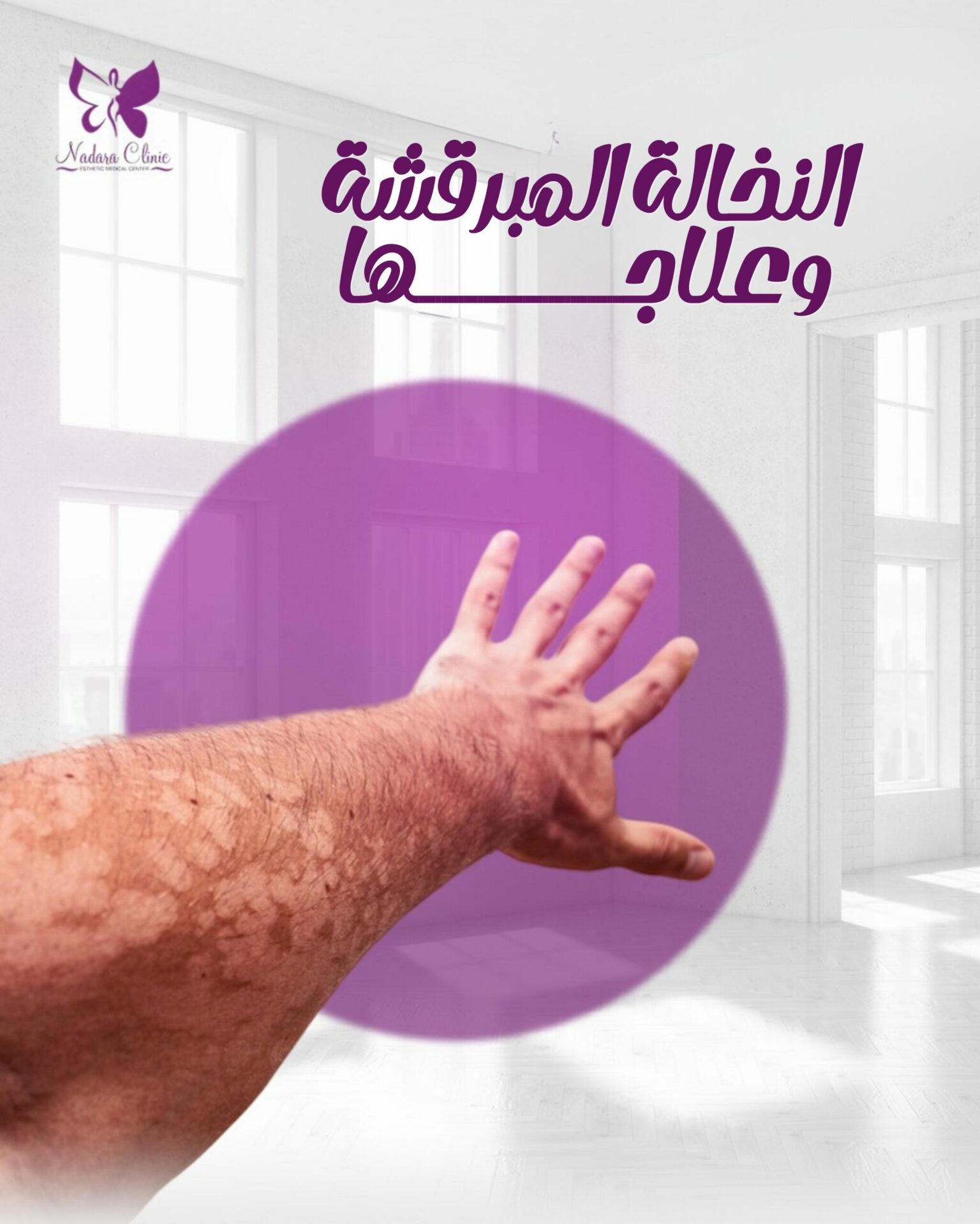 النخالة المبرقشة وعلاجها